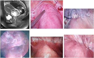 A Retrospective Analysis of the Treatment of Cesarean Scar Pregnancy by High-Intensity Focused Ultrasound, Uterine Artery Embolization and Surgery